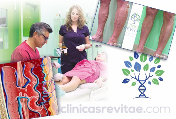 Fleboterapia Regenerativa Tridimensional, el único tratamiento que cura las varices sin eliminarlas, en franquicias Revitae.